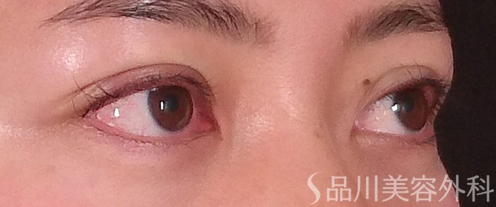 症例NO.70256のAFTER写真