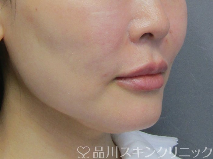 症例NO.75119のAFTER写真