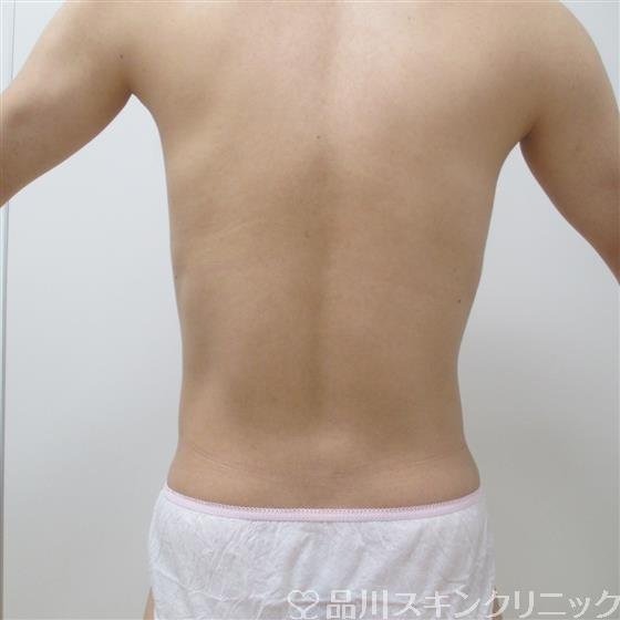 症例NO.27605のAFTER写真