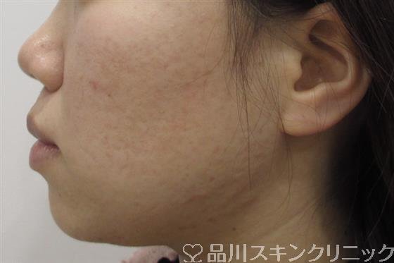 症例NO.42869のAFTER写真
