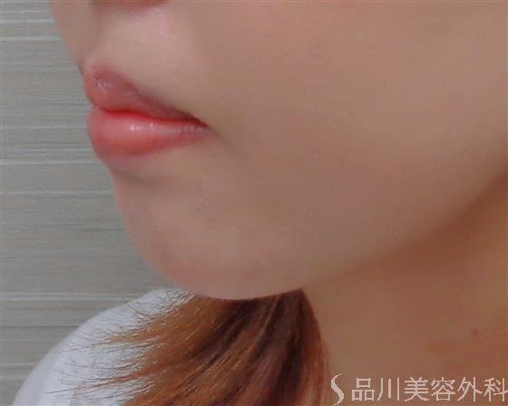 症例NO.60434のAFTER写真