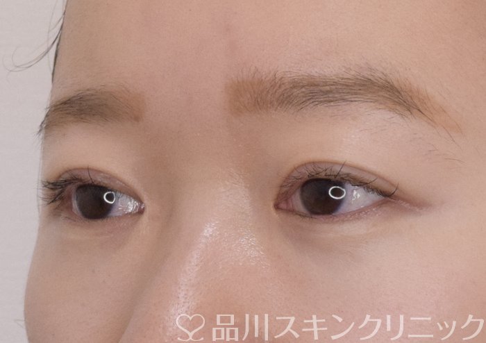 症例NO.69571のAFTER写真