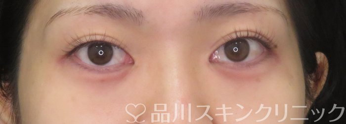 症例NO.74939のAFTER写真