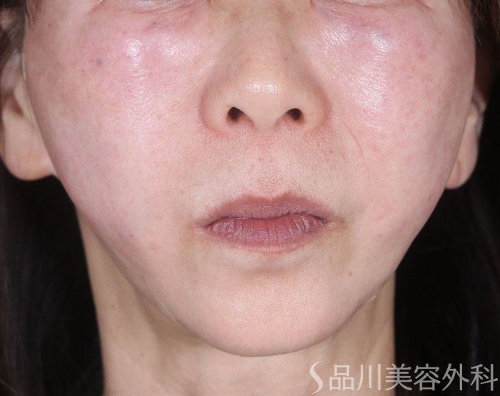 症例NO.72945のAFTER写真