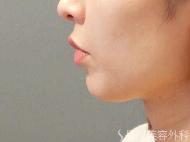 症例NO.64984のBEFORE写真