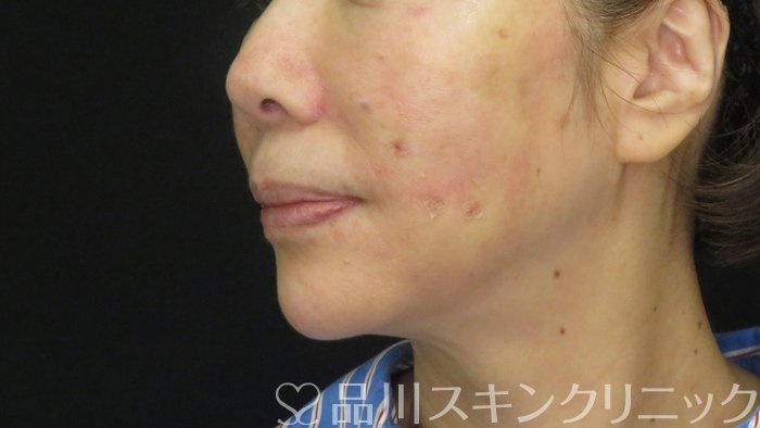 症例NO.72272のAFTER写真