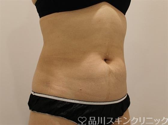 症例NO.45190のAFTER写真