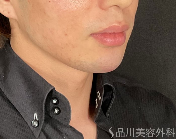 症例NO.74573のAFTER写真