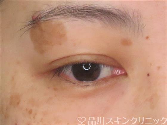 症例NO.61104のBEFORE写真