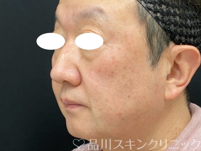 症例NO.74029のAFTER写真