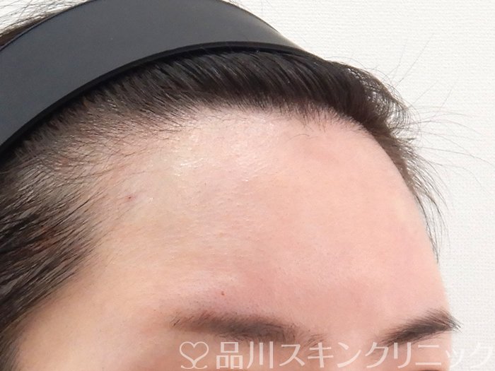 症例NO.63681のAFTER写真