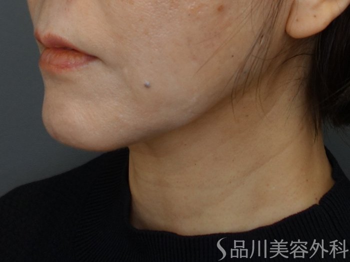 症例NO.74629のBEFORE写真