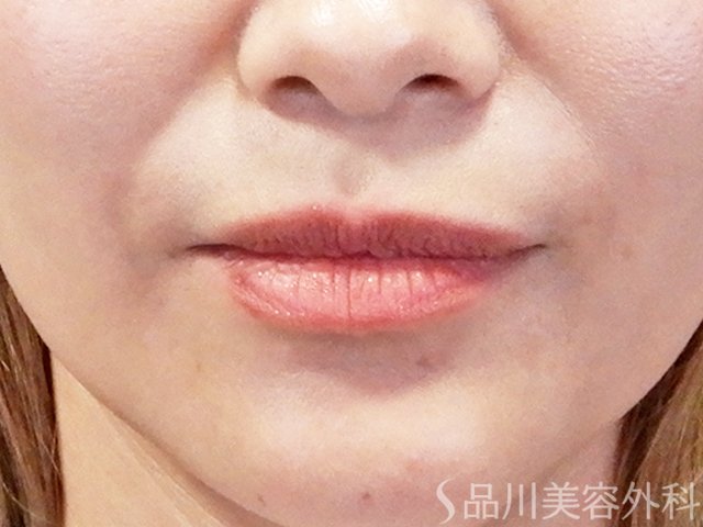 症例NO.67708のBEFORE写真