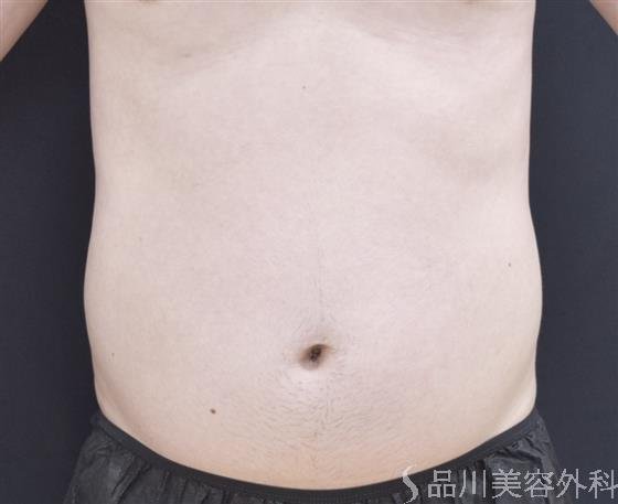 症例NO.44243のBEFORE写真