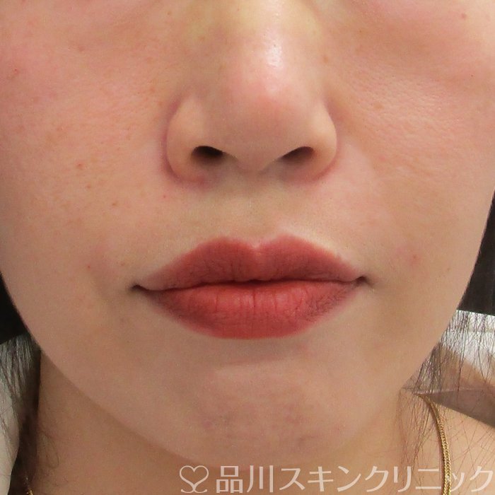 症例NO.75294のAFTER写真