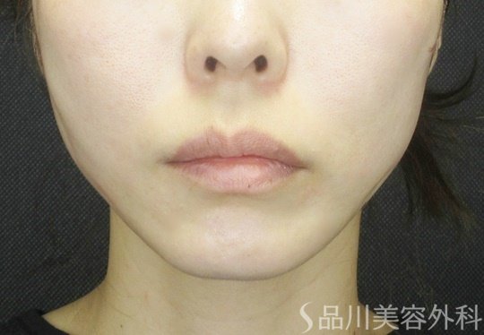 症例NO.69089のAFTER写真