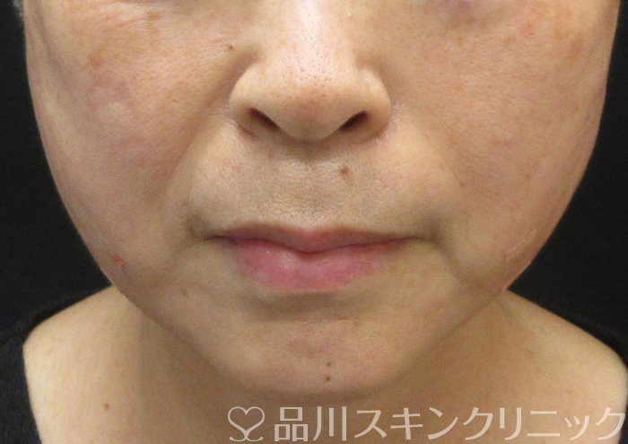 症例NO.73998のAFTER写真