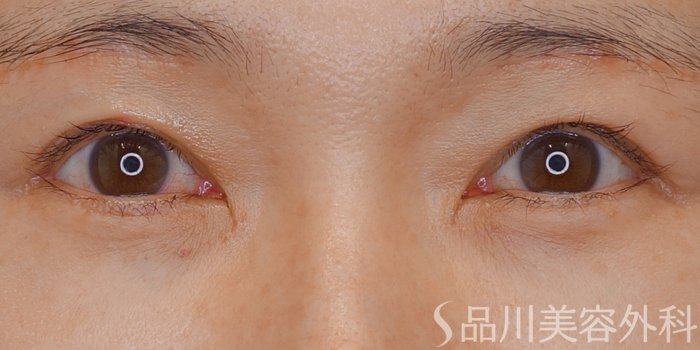 症例NO.70139のAFTER写真