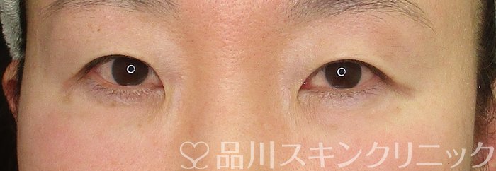 症例NO.70494のBEFORE写真