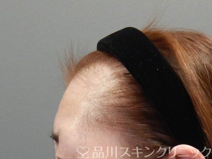 症例NO.73039のBEFORE写真