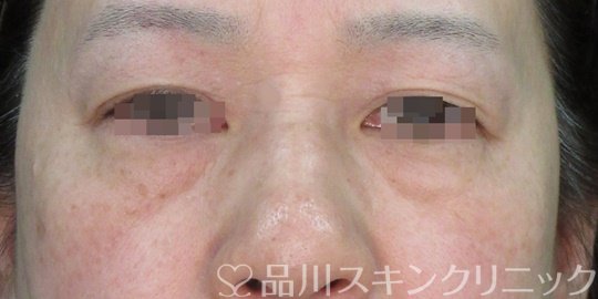 症例NO.74219のBEFORE写真