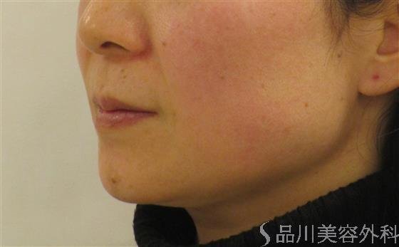 症例NO.58803のBEFORE写真