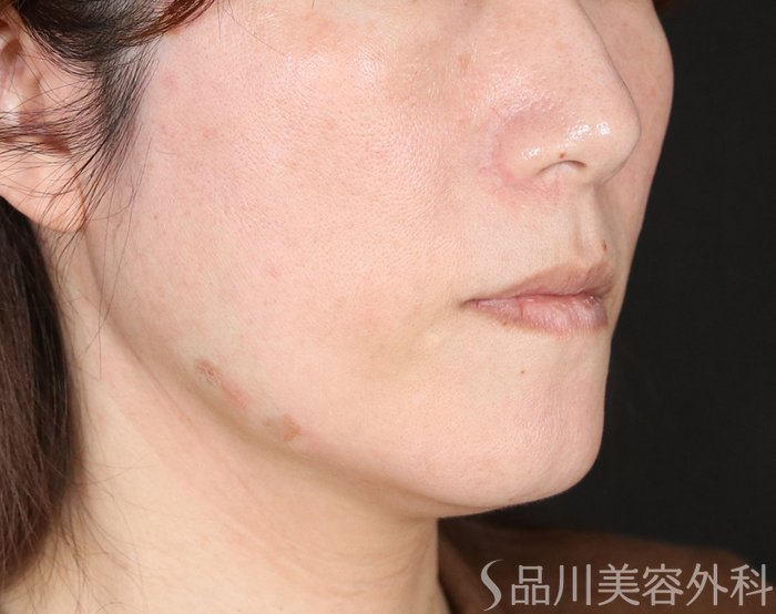 症例NO.72220のAFTER写真