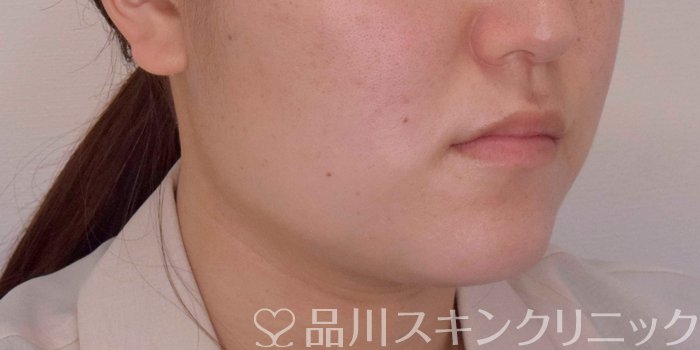 症例NO.68070のBEFORE写真