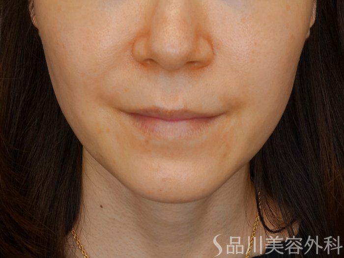 症例NO.70209のBEFORE写真