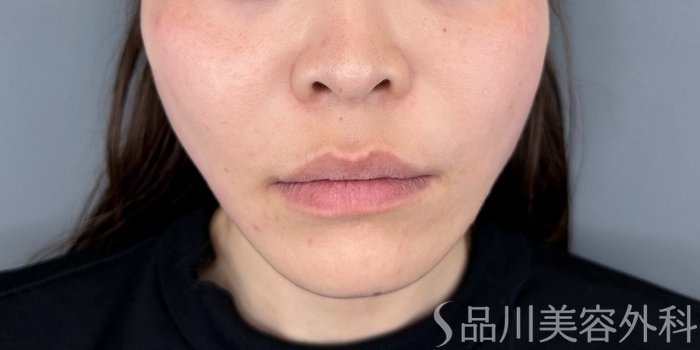 症例NO.70705のAFTER写真