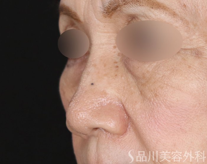 症例NO.71493のBEFORE写真