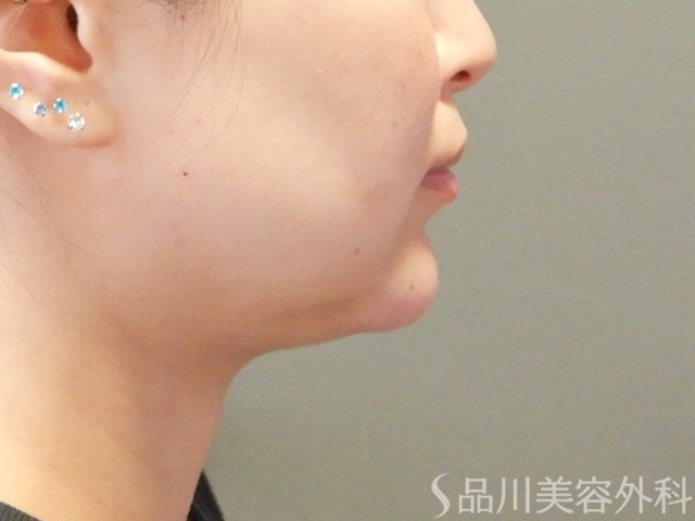 症例NO.65569のAFTER写真