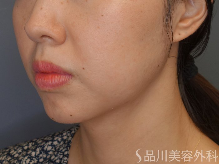 症例NO.71915のBEFORE写真