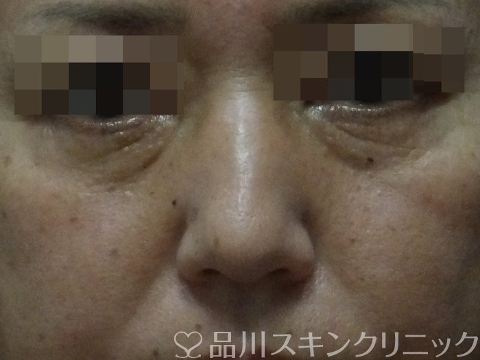 症例NO.71376のBEFORE写真