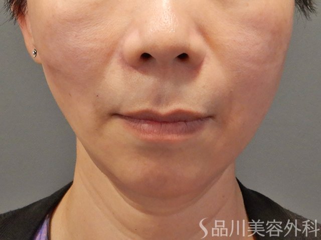 症例NO.74312のAFTER写真