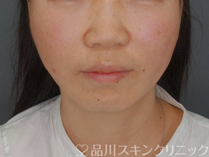 症例NO.74181のAFTER写真