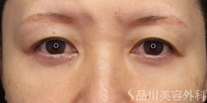 症例NO.75080のBEFORE写真