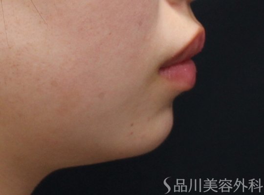 症例NO.73399のAFTER写真