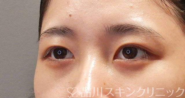 症例NO.75057のAFTER写真