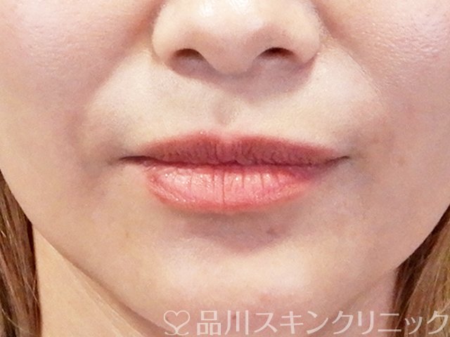 症例NO.67708のBEFORE写真