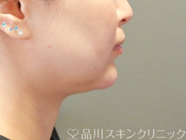 症例NO.65569のAFTER写真