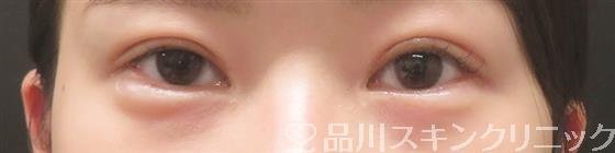 症例NO.59158のAFTER写真