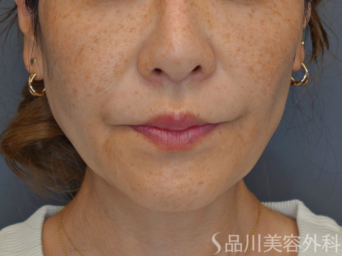 症例NO.73995のBEFORE写真