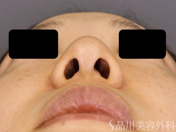 症例NO.72520のBEFORE写真