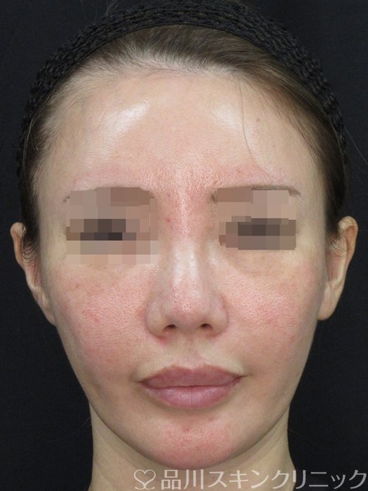 症例NO.72527のBEFORE写真