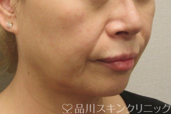 症例NO.72768のBEFORE写真