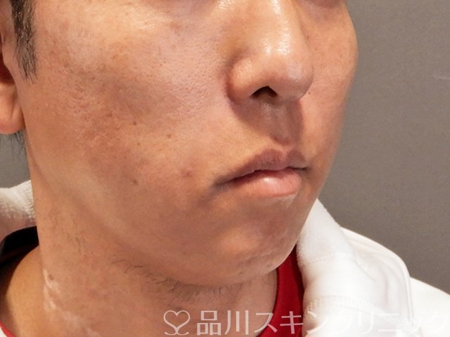 症例NO.70490のAFTER写真