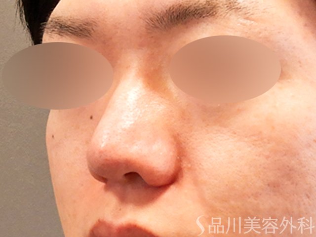 症例NO.70282のAFTER写真