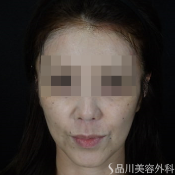 症例NO.73836のBEFORE写真