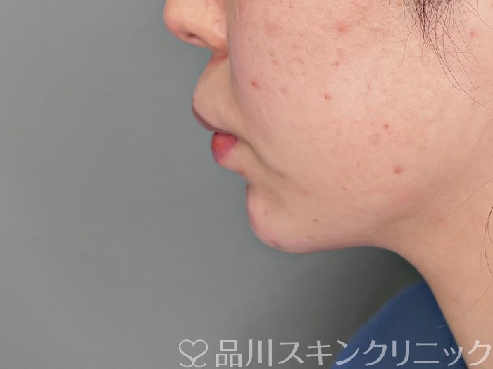 症例NO.70052のAFTER写真